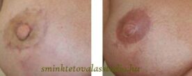 Mellbimbó (areola) tetoválás, Sminktetoválás Budapest