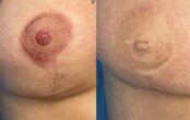 Mellbimbó (areola) tetoválás, Sminktetoválás Budapest
