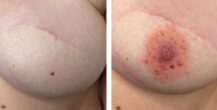 Mellbimbó (areola) tetoválás, Sminktetoválás Budapest