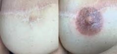 Mellbimbó (areola) tetoválás, Sminktetoválás Budapest